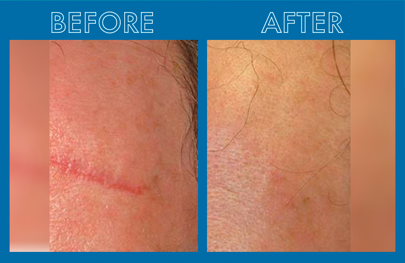 before_after-VOSSMAN_scar_5841d884-04c8-4dec-bbf0-b3f14123a5a9.png