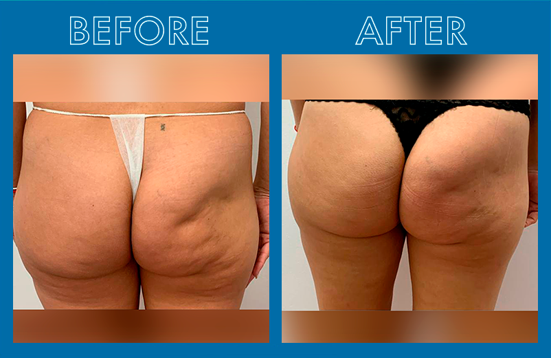 before_after-VOSSMAN-3_08d3e023-dc46-4c9e-888a-3d18a3d2c8c3.png