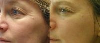 Before and after Omnilux combination phototherapy 