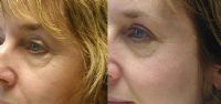 Before and after Omnilux combination phototherapy 